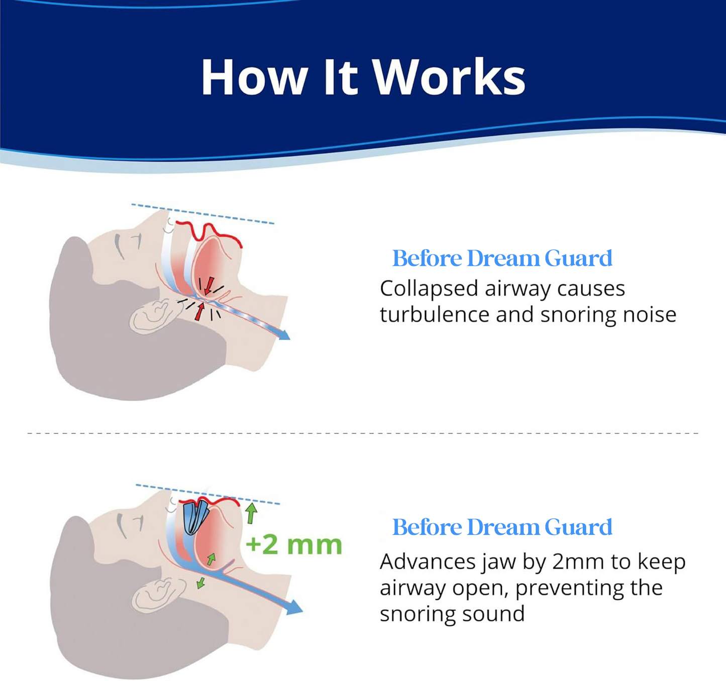 The DreamGuard Anti-Snoring Mouthpiece